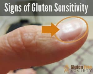gluten sensitivity and iron deficiency