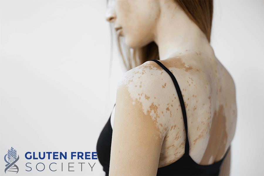 gluten and vitiligo